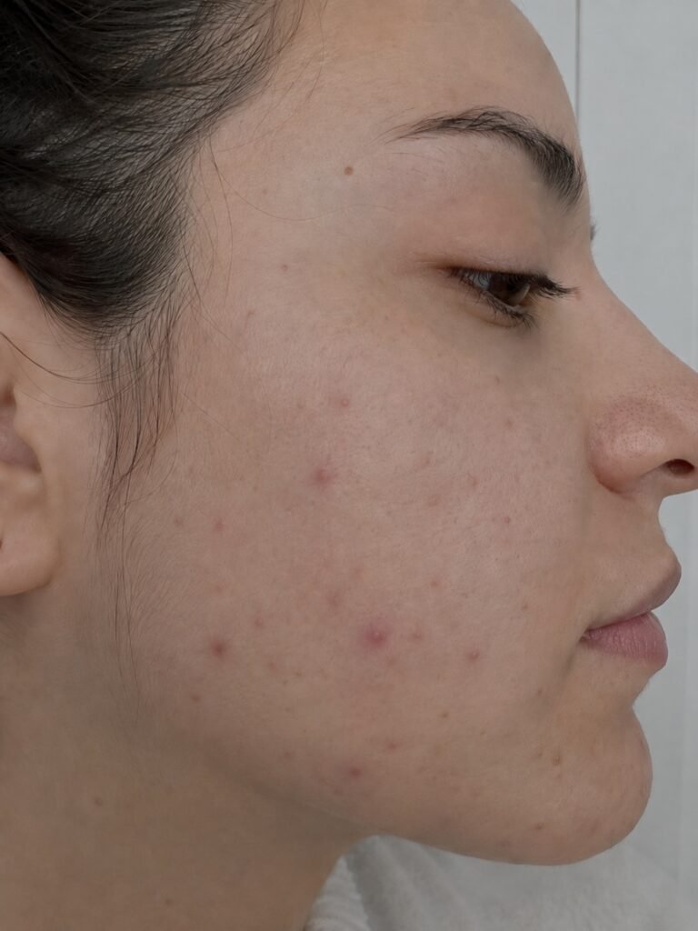 PIEL Y CABELLO acne adulto mujer
