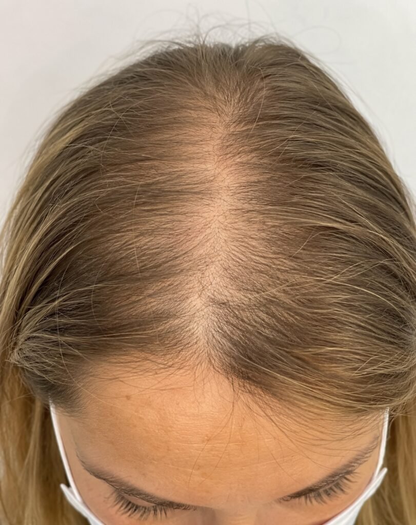 alopecia androgenética femenina