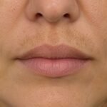 Melasma: qué es, por qué aparece y cómo reconocerlo melasma en la cara